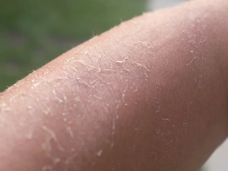 How To Get Rid of Dry Skin And Get Your Glow Back