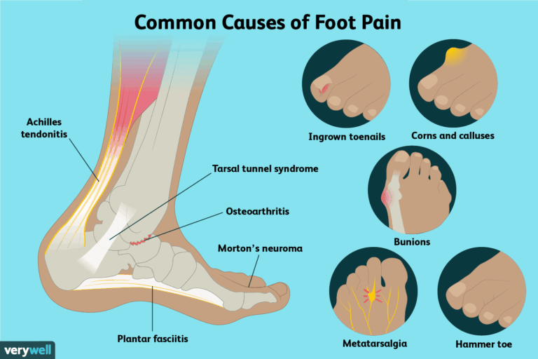 5 Common Causes of Foot Pain