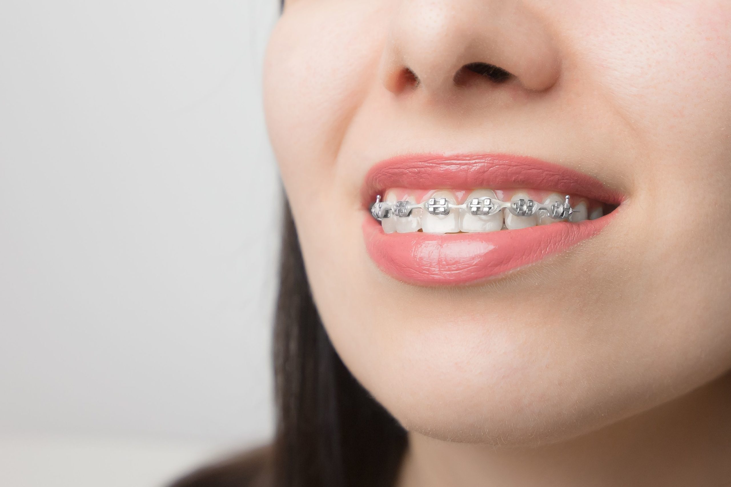 Aligners vs Braces: Which is an affordable option? 